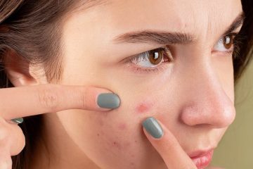 woman squeezing her pimples with her fingers