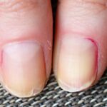 Ongles fragiles et cheveux ternes : décrypter les carences